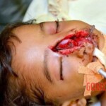 Surgery of little boy