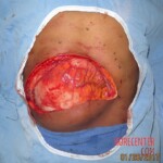 Giant tumor