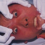 Hanged woman in morgue