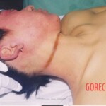 Hanged woman in morgue