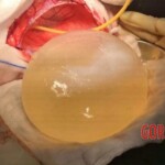 Huge cyst