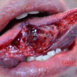 Tongue splitting