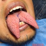 Fissured tongue with tongue split