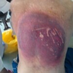 Suppurative-necrotic phlegmon