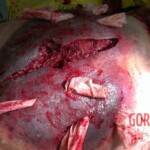 Suppurative-necrotic phlegmon