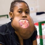 Huge facial tumor