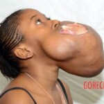 Huge facial tumor