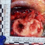 Girl impaled on railing