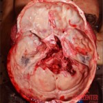 Girl impaled on railing