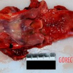 Tongue and pharynx Autopsy of young Chinese woman