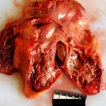 Heart cut open Autopsy of young Chinese woman