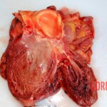 Heart cut open Autopsy of young Chinese woman