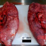 Lungs Autopsy of young Chinese woman