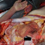 Intestines and omentum Autopsy of young Chinese woman