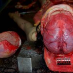 Dura matter Autopsy of young Chinese woman