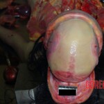 Skull Autopsy of young Chinese woman