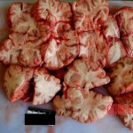 Dissected brain Autopsy of young Chinese woman