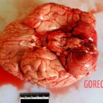 Brain bottom Autopsy of young Chinese woman