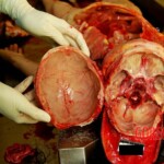 Skull base and calvaria Autopsy of young Chinese woman