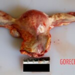 Uterus Autopsy of young Chinese woman