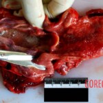 Tongue and pharynx Autopsy of young Chinese woman