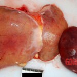 Liver and spleen Autopsy of young Chinese woman
