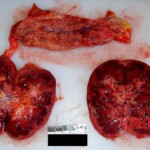 Kidneys cut open and pancreas above Autopsy of young Chinese woman