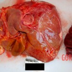 Undersurface of liver and spleen Autopsy of young Chinese woman