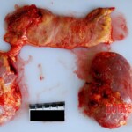 Kidneys intact and pancreas Autopsy of young Chinese woman