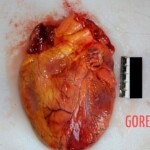 Front of heart Autopsy of young Chinese woman