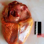 Back of heart Autopsy of young Chinese woman