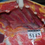 Autopsy of Chinese woman