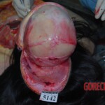 Autopsy of Chinese woman