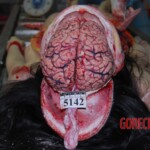 Autopsy of Chinese woman