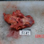 Autopsy of Chinese woman