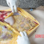 Autopsy of Chinese girl