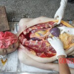 Autopsy of Chinese girl