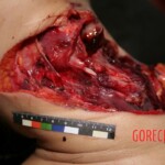 Autopsy of stabbed girl