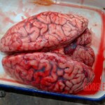 Brain autopsy