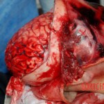 Brain autopsy
