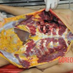 Stabbed woman in morgue