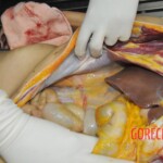 Stabbed woman in morgue