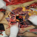 Stabbed woman in morgue