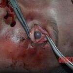 Strangled woman in morgue