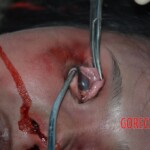 Strangled woman in morgue