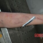 Strangled woman in morgue