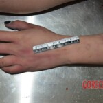 Strangled woman in morgue