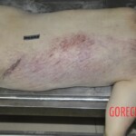 Female corpse in morgue