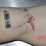 Female corpse in morgue