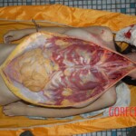 Autopsy of pregnant woman